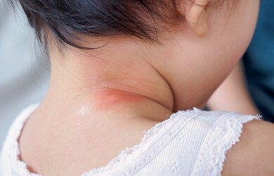 baby skin rashes